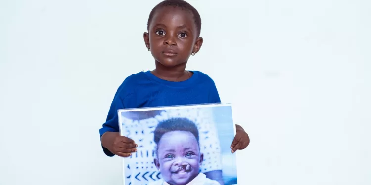 Graft Foundation to offer free reconstructive surgeries in Ashanti Region