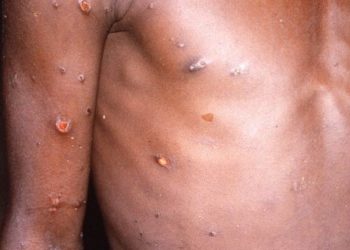 9 things you need to know about Mpox