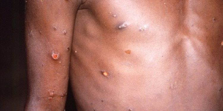 9 things you need to know about Mpox