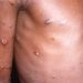 9 things you need to know about Mpox